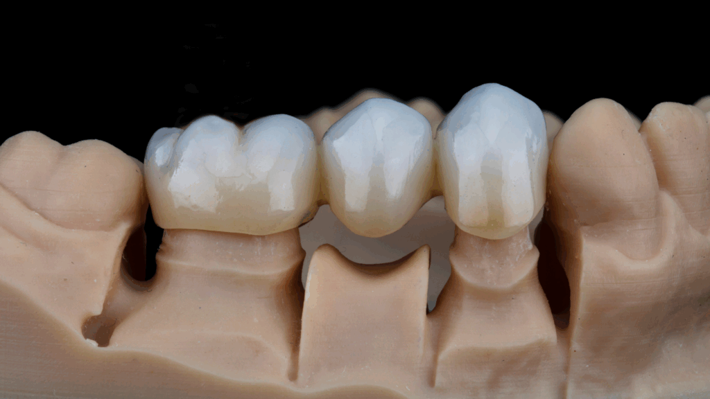 Should I Get a Dental Bridge? | Lincolnshire, IL